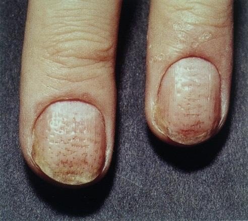 Nagelpsoriasis
