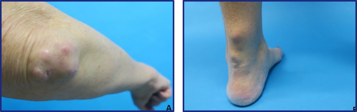 Vormen van psoriasis
